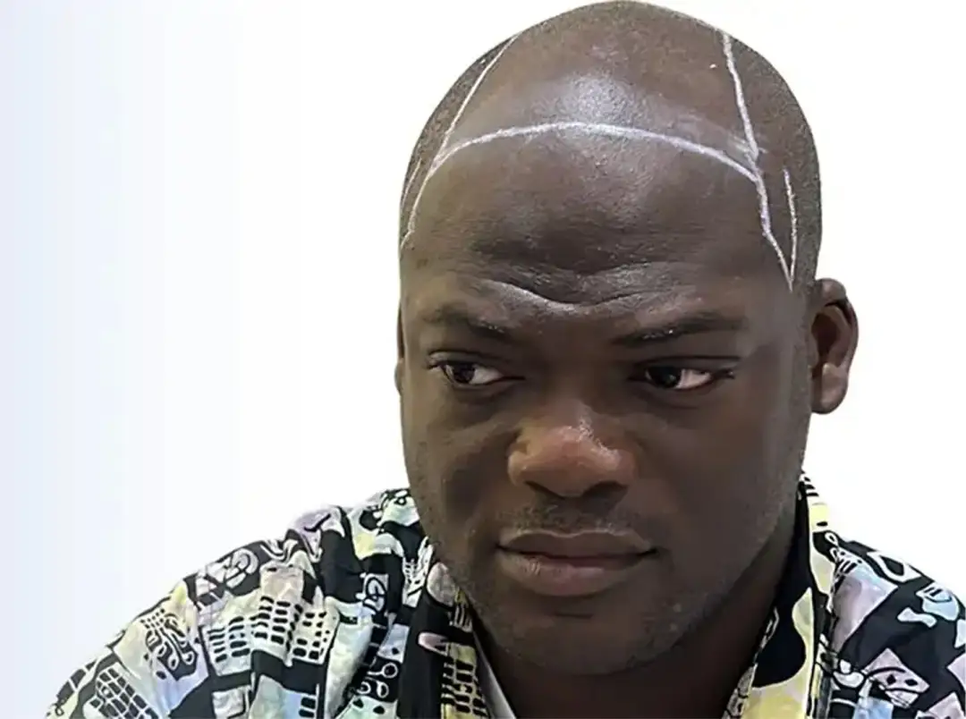 An unidentified patient with a shaved head and a proposed hairline drawn on the scalp in white marker, photographed against a plain background.