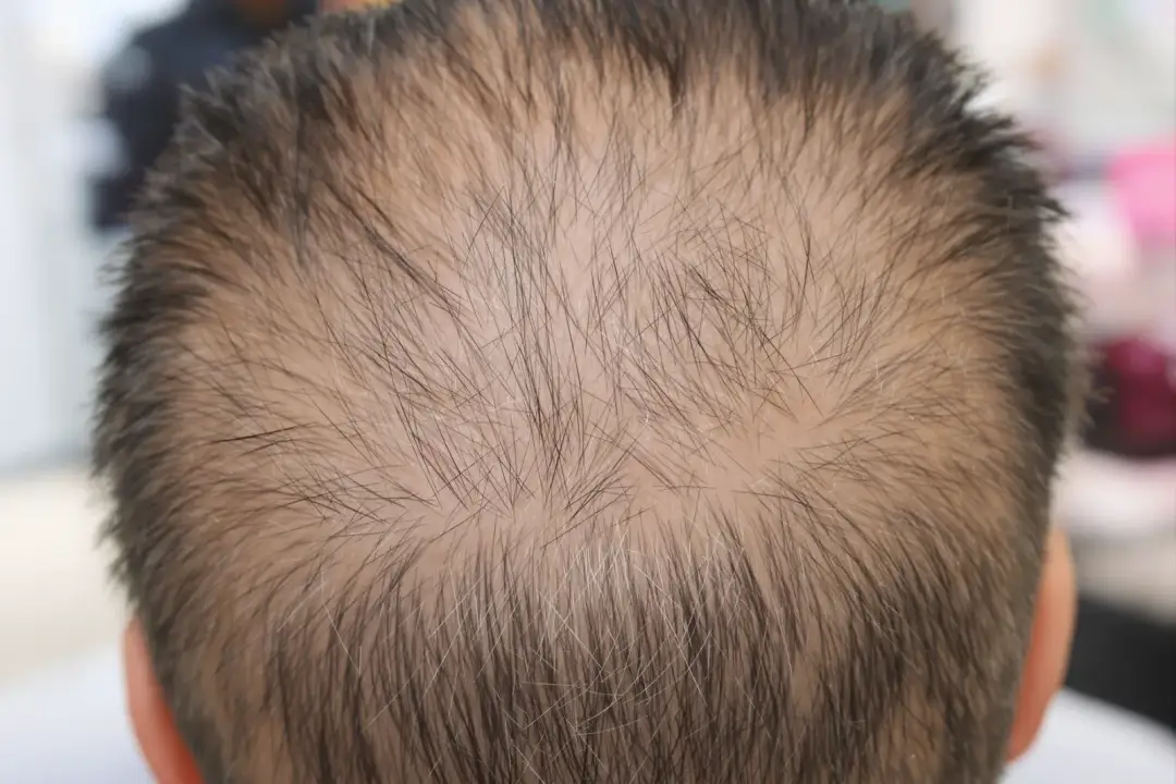 Chiedere cosa accade quando cambia il piano   Domande sul rientro — Le domande da portare a una clinica per il trapianto di capelli – featured image from Istanbul Care