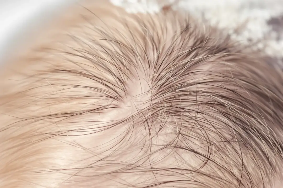 Adderall Hair Loss Treatment Options Explained