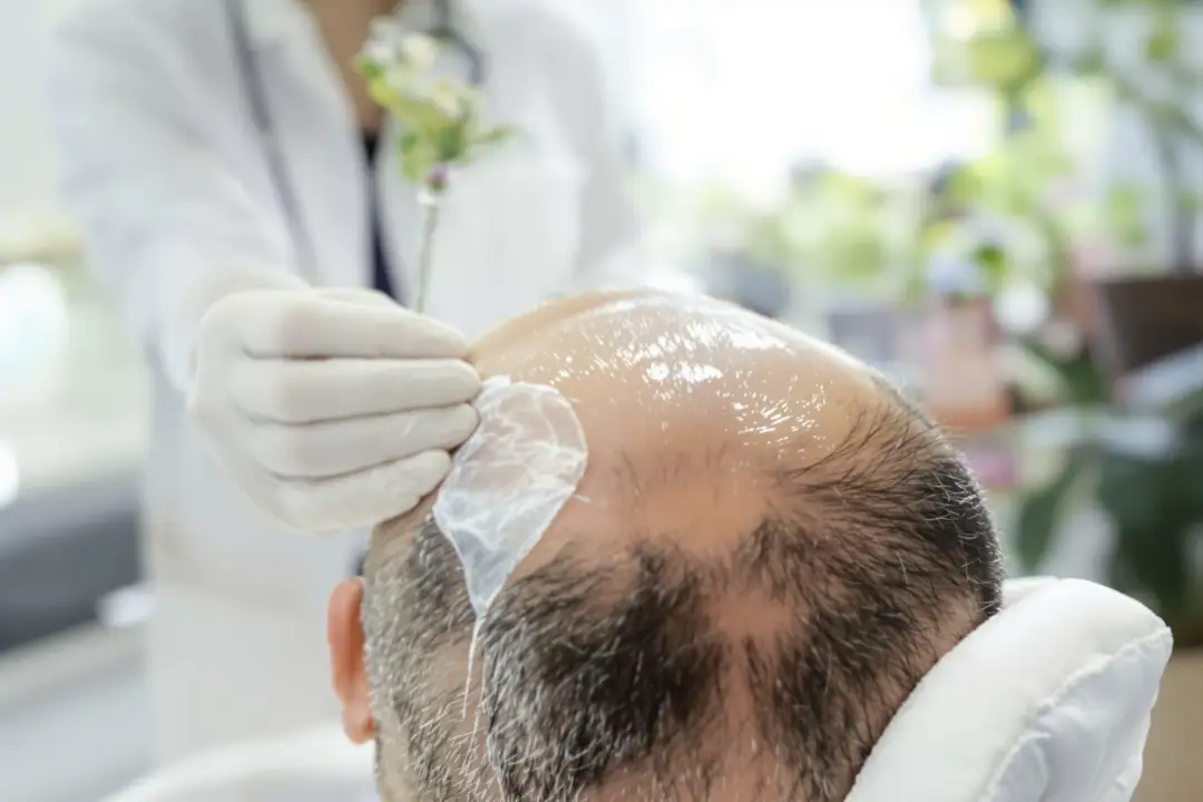 Questions to Ask Before Choosing a Hair Transplant Clinic in Istanbul —  Keep the itinerary adjustable, Plan the journey home – featured image from Istanbul Care