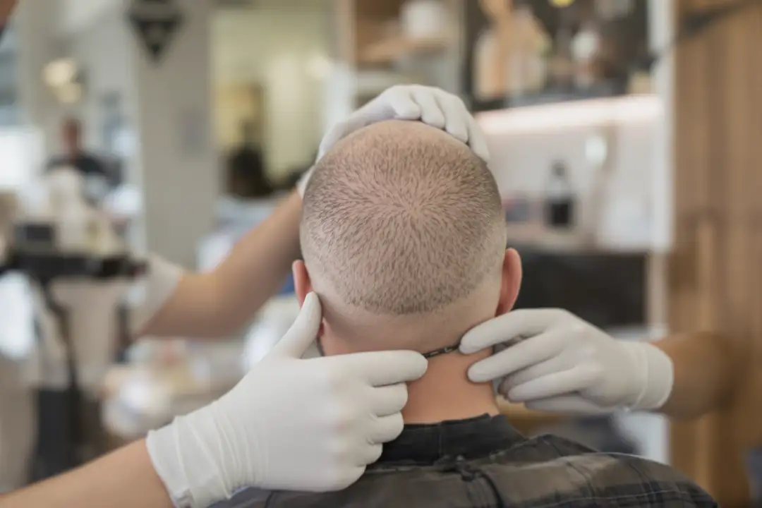 Hair Restoration Solutions for Bald Men