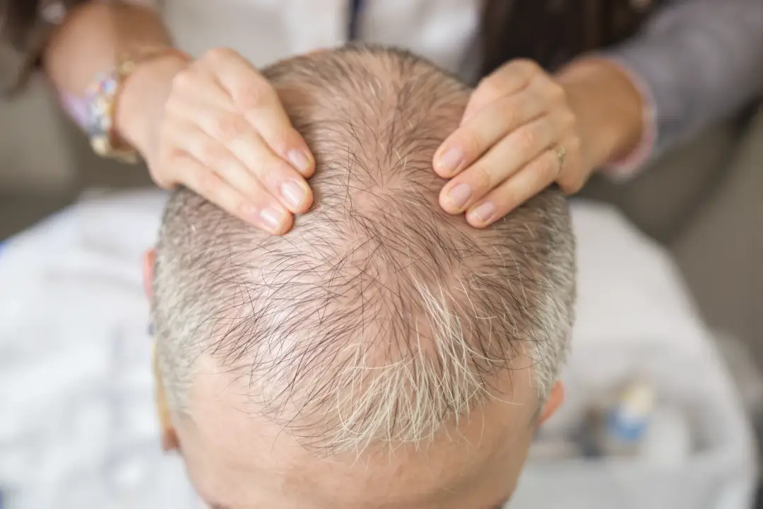 Bald People Restoration: Facts and Myths