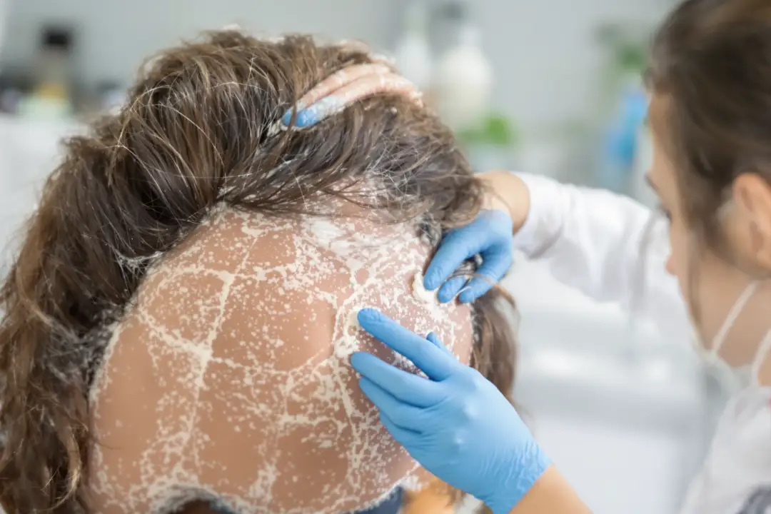 Dandruff and Hair Loss: What's the Connection?