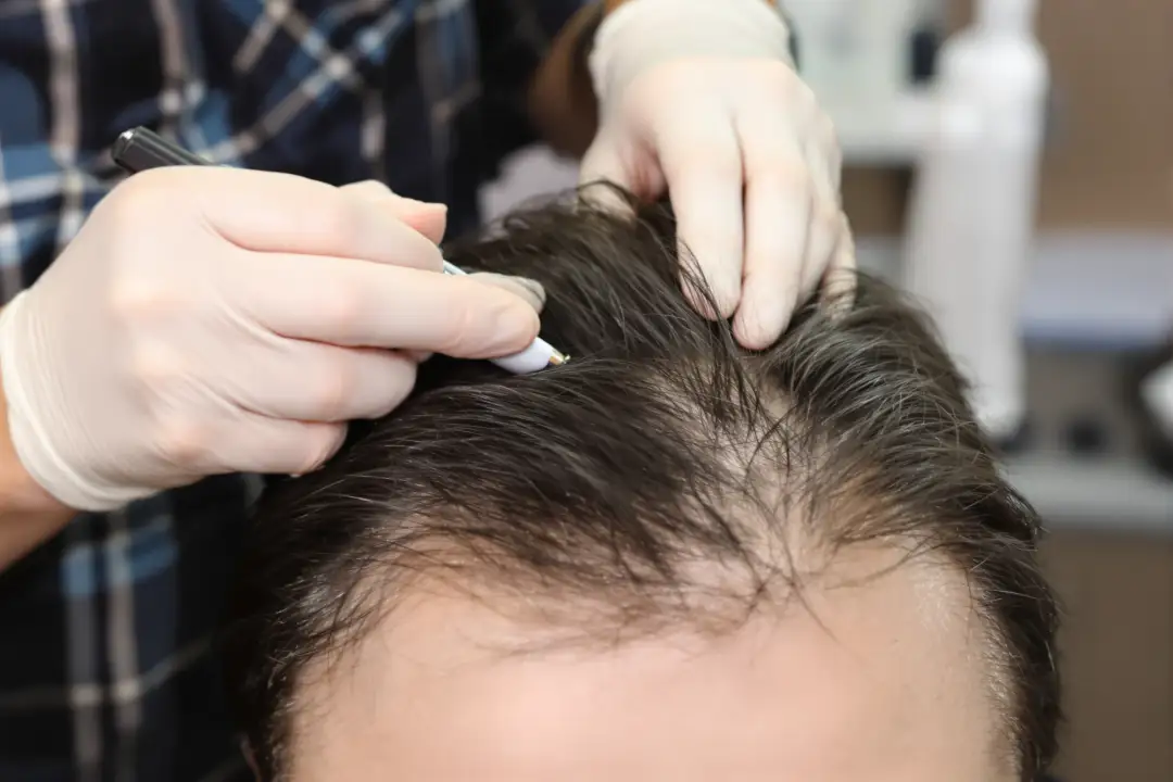 DHI Hair Transplant Turkey: Frequently Asked Questions