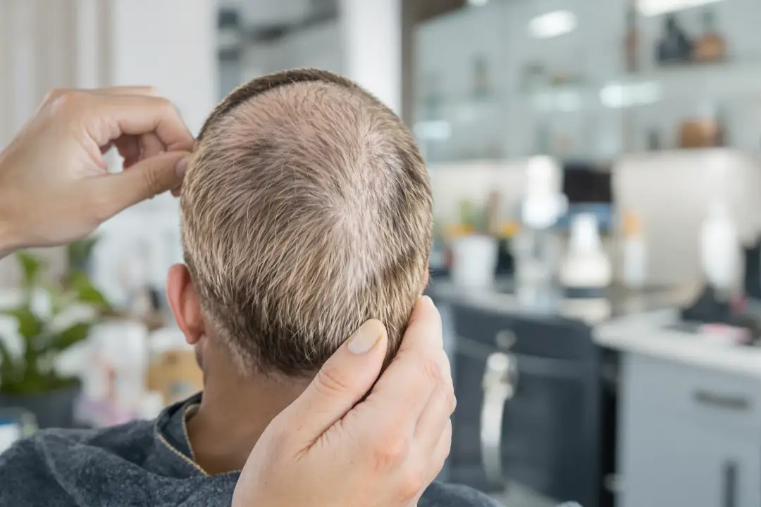 DHT Blocker Basics for Hair Loss
