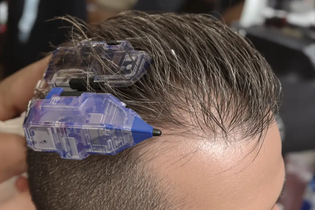 FUE Hair Transplant Turkey: FAQs Answered