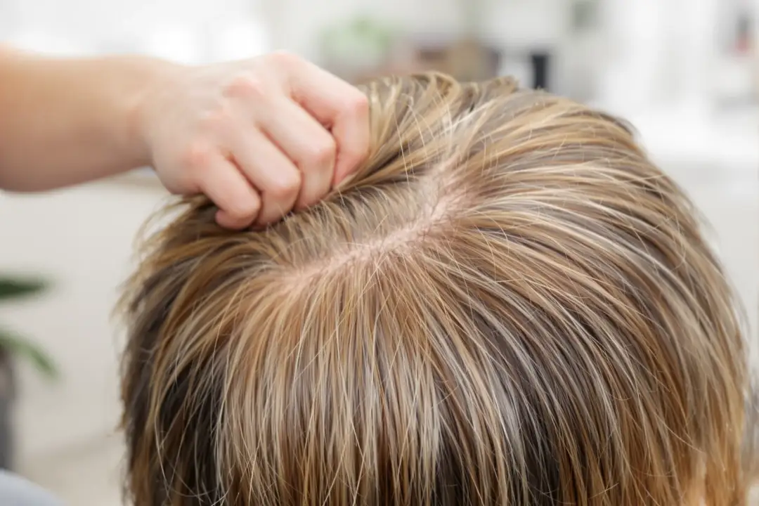 Hair Loss: Causes and Treatments FAQ