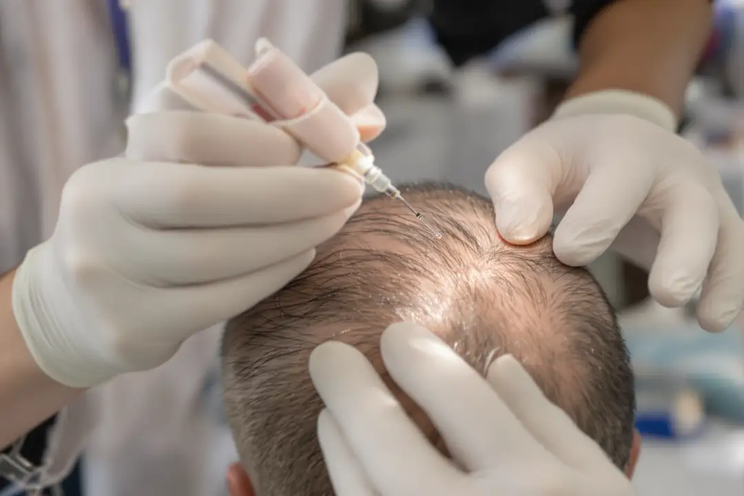 Understanding Hair Transplant Anaesthesia