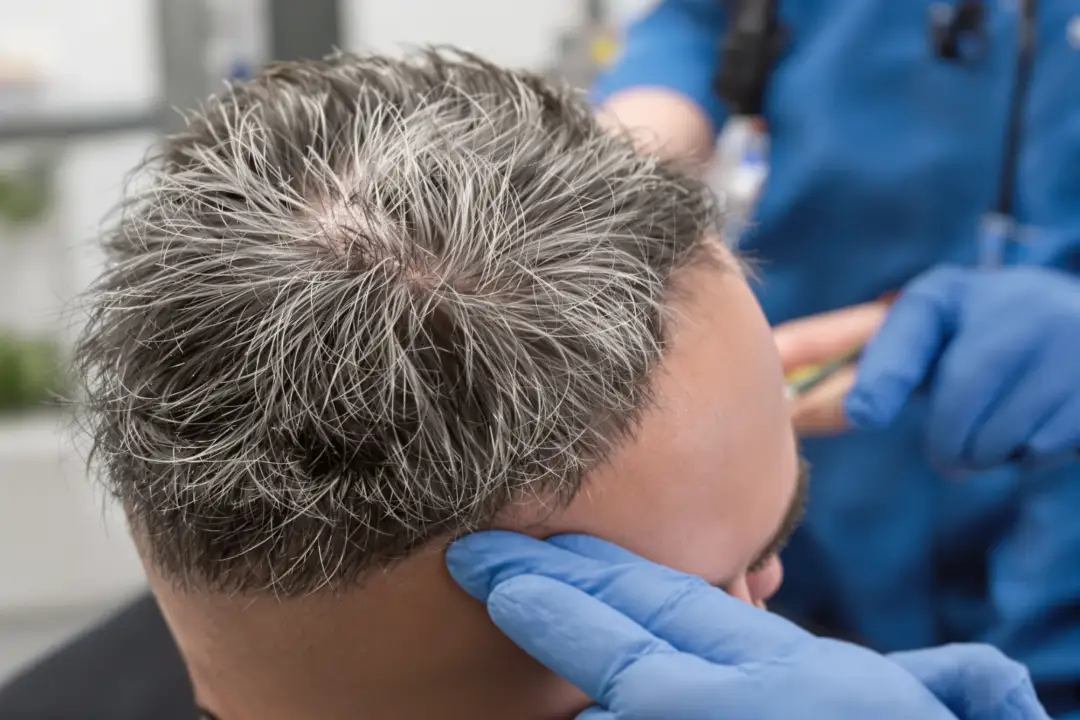 Hair Transplant Before After: Key Milestones