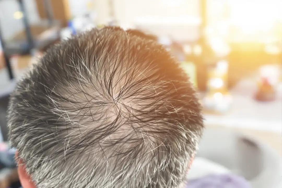 Hair Transplant Before and After Timeline