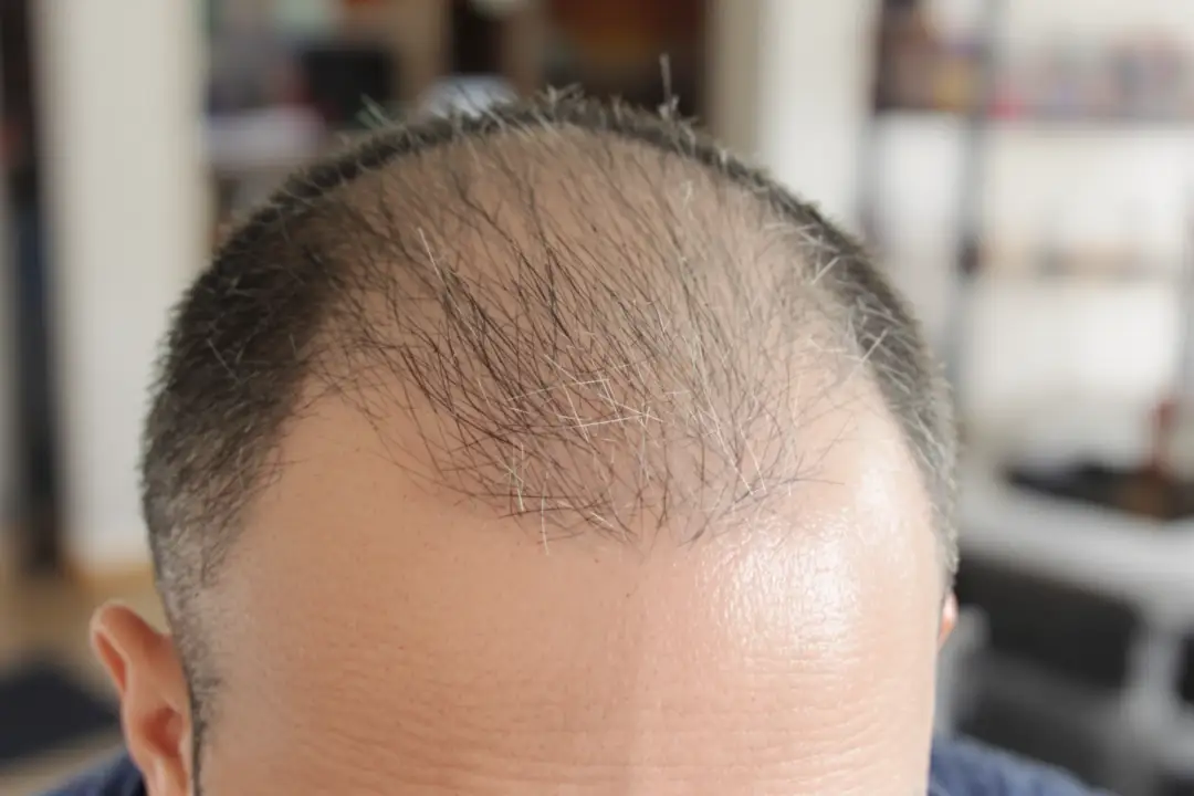 Norwood 5 Hair Loss: Facts About Stage 5