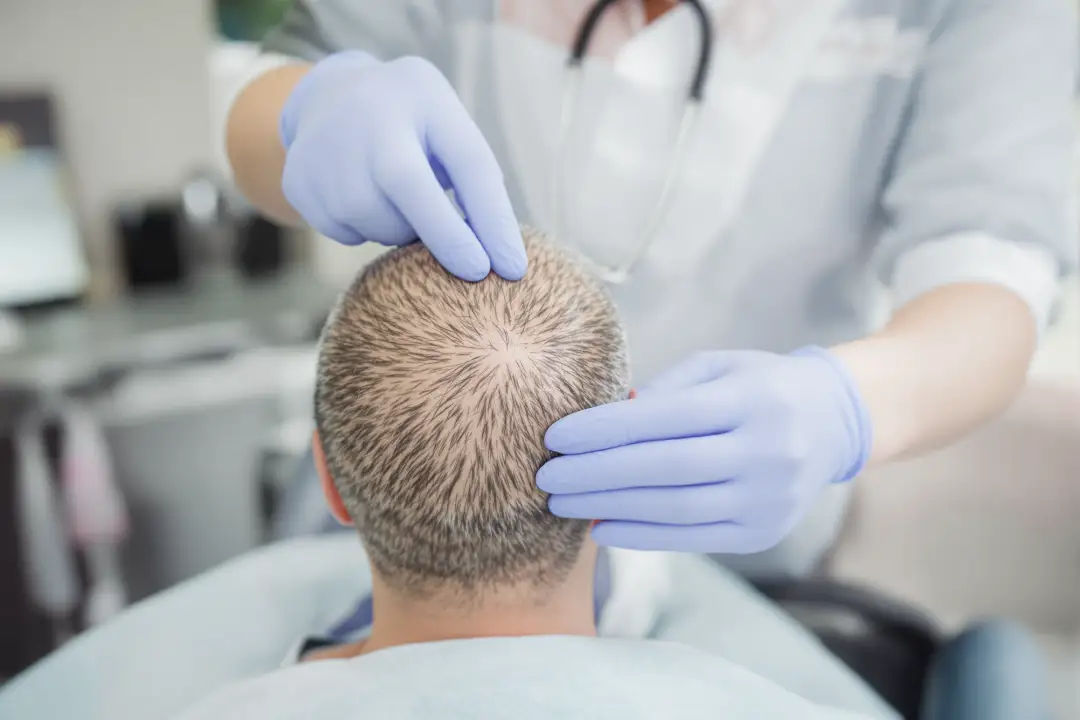 Hair Transplant: Techniques, Candidates, and Recovery