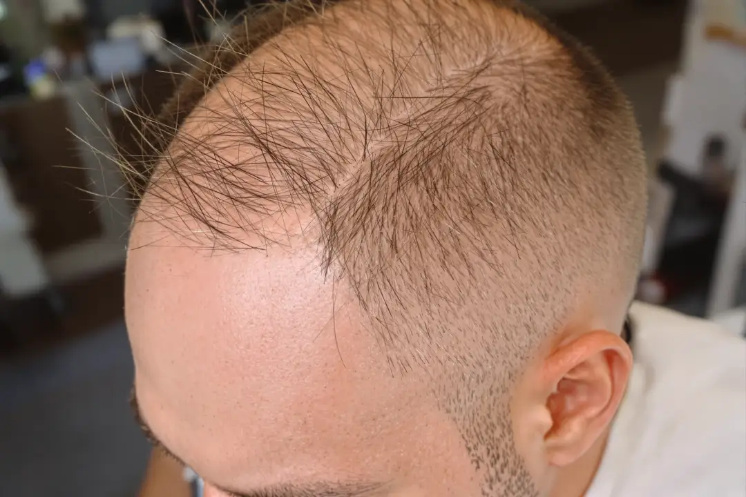 Norwood 2 Hair Transplant Before and After