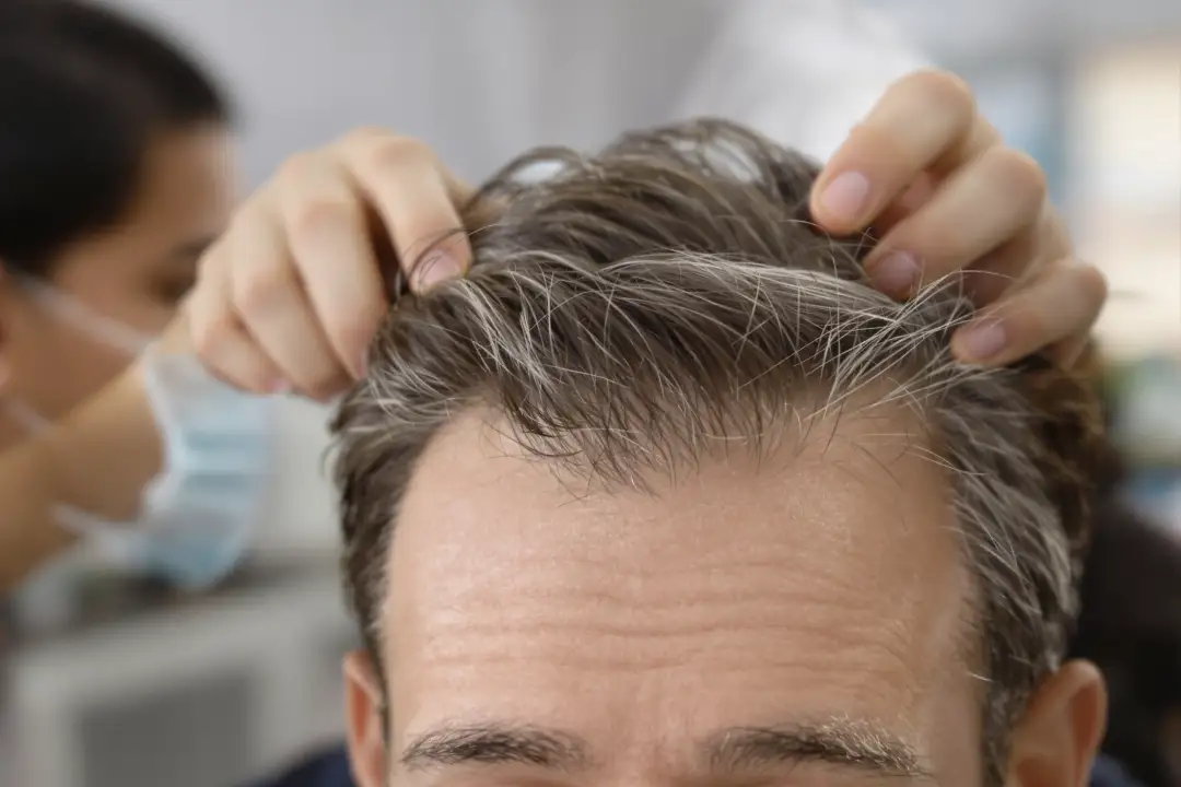 How to Fix a Receding Hairline: Non-Surgical Options vs Hair Transplant