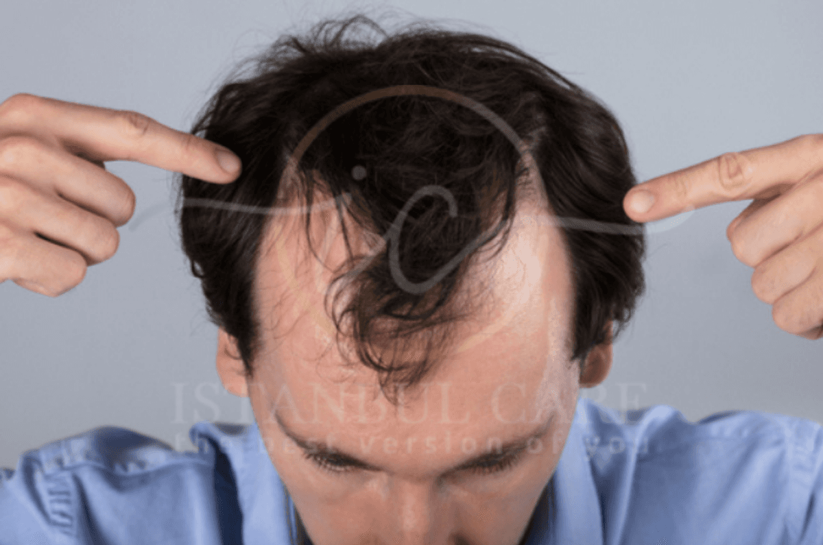 Man pointing at his receding temples, a common pattern of stress-related hair loss – Istanbul Care