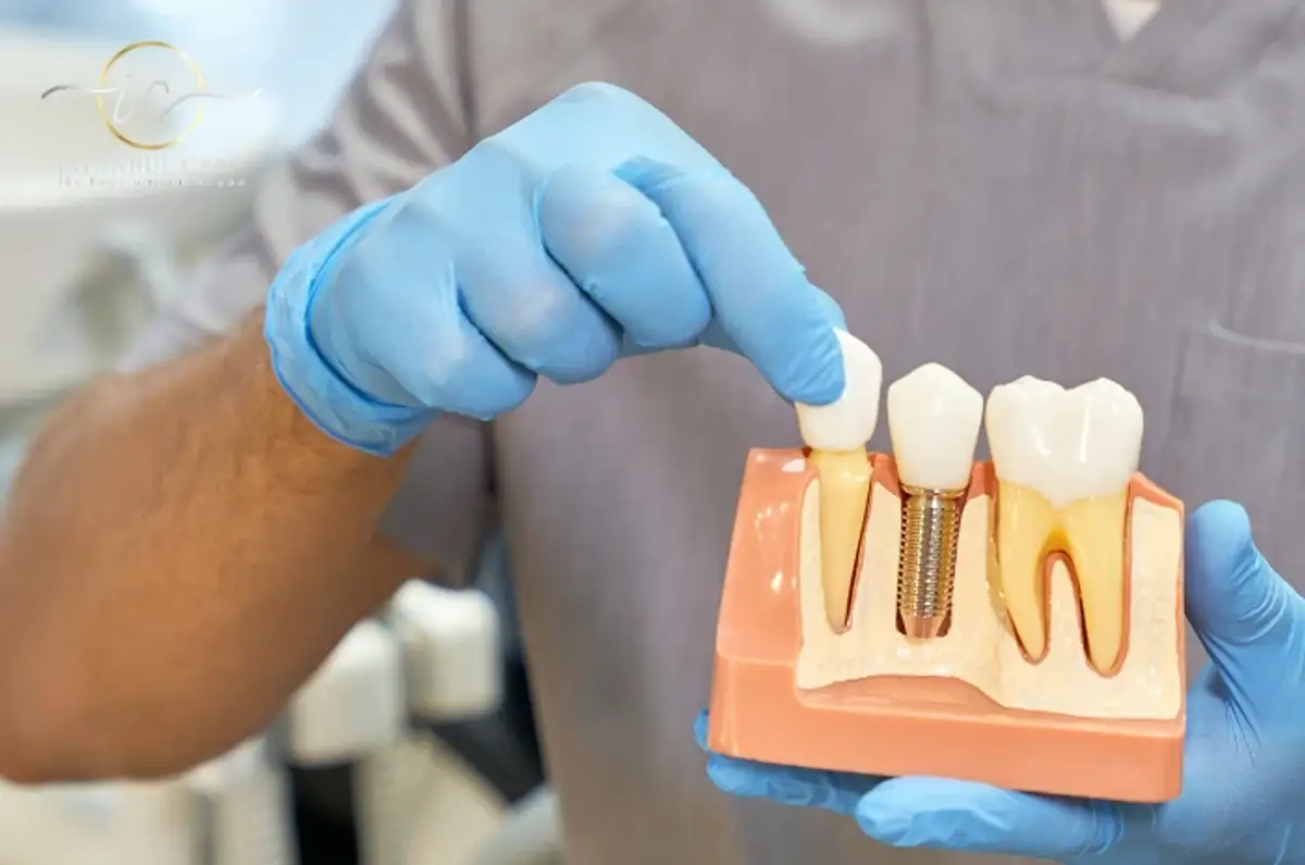 Implant dentar