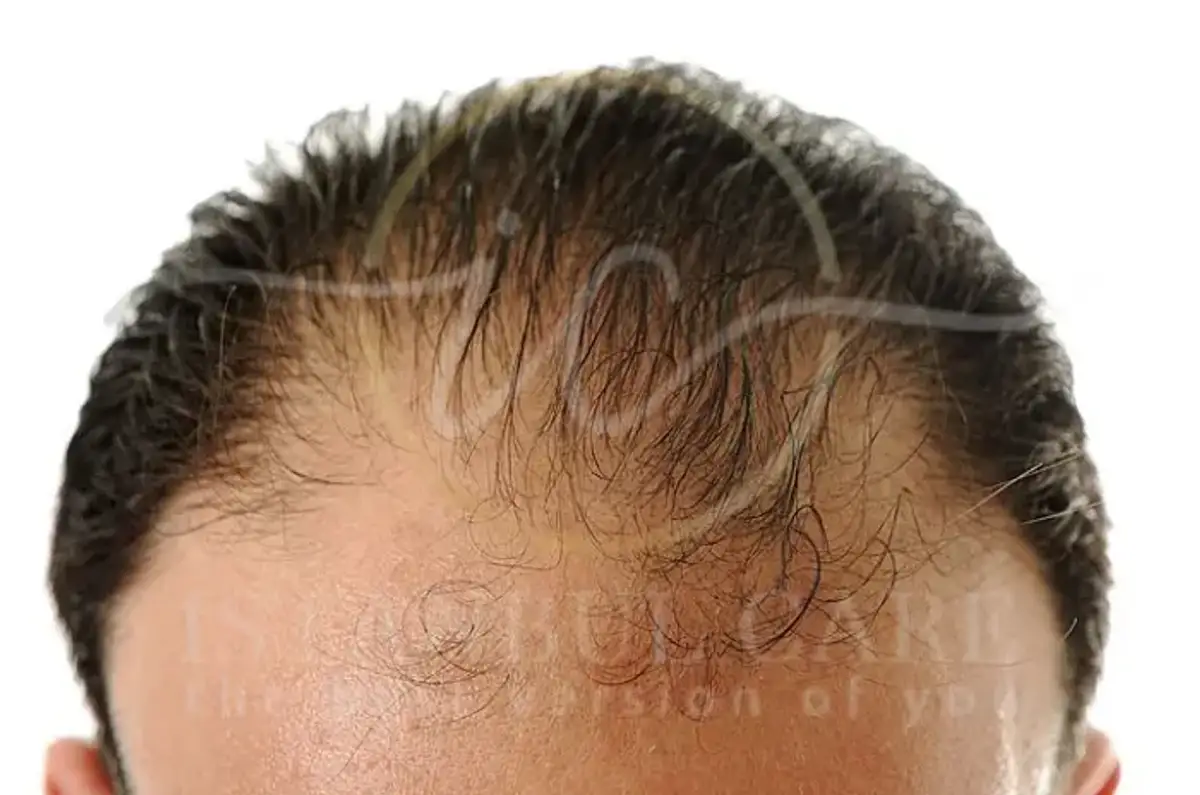 Informazioni dettagliate su se le carenze di vitamine e minerali causano la caduta dei capelli