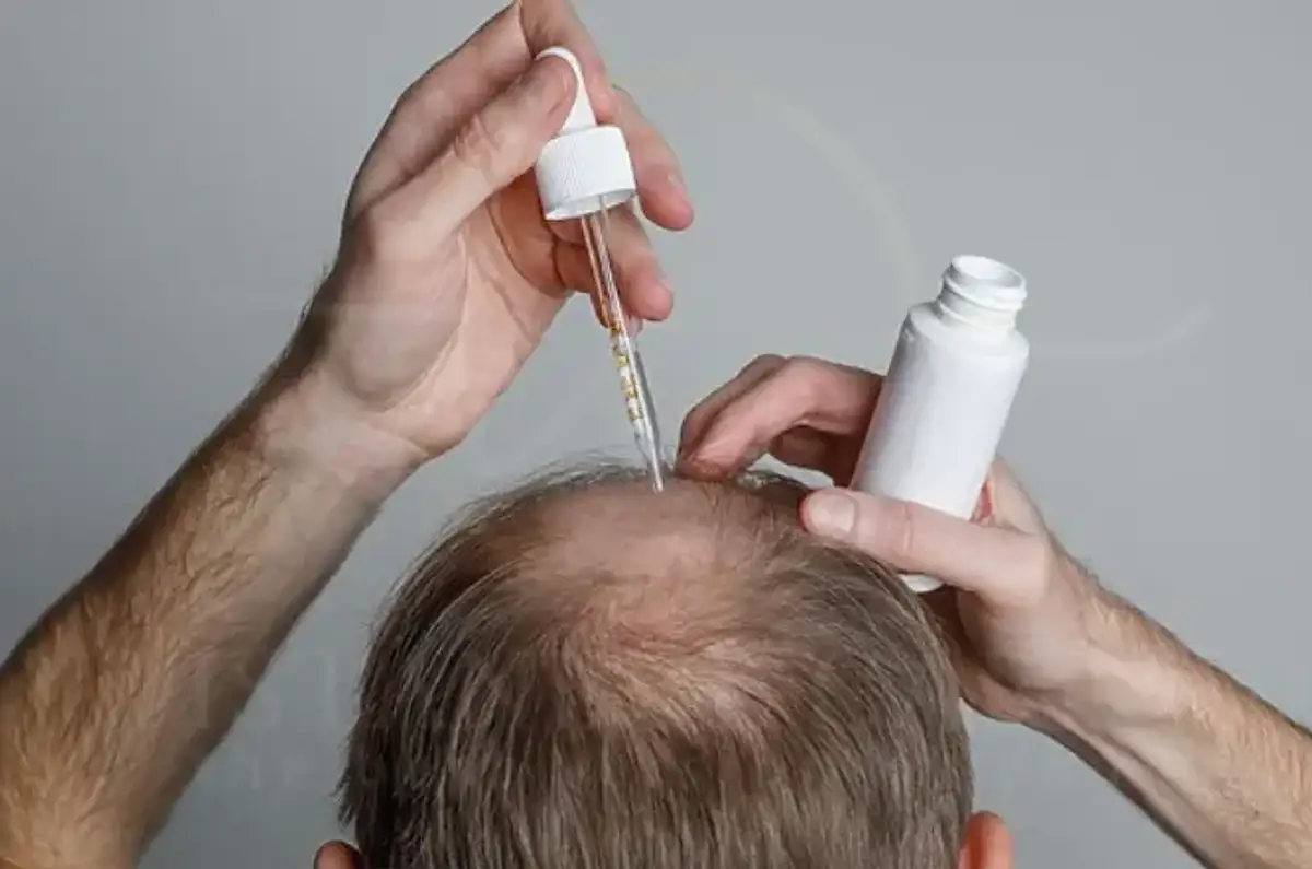 Does Hims Work for Hair Loss Treatments, Costs & Reviews