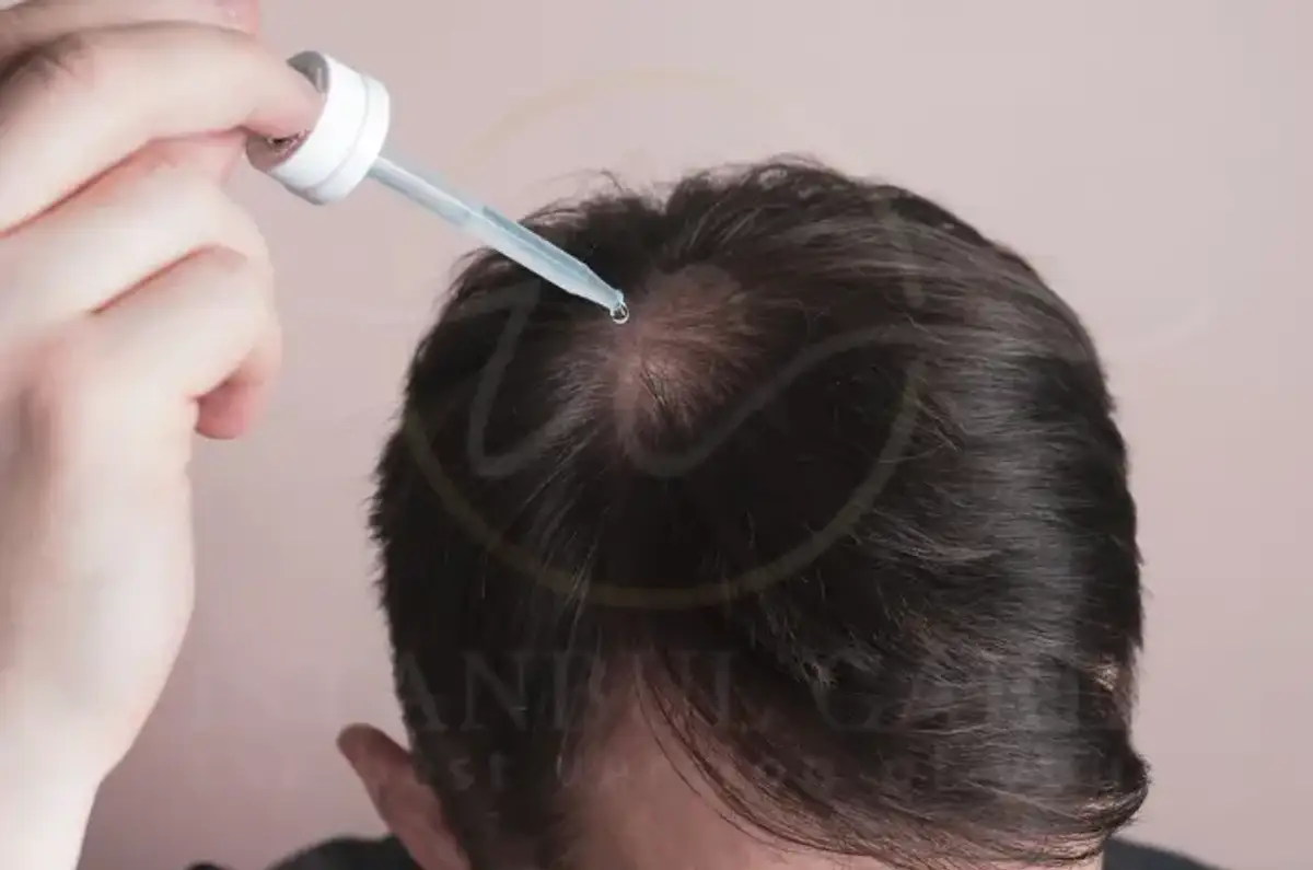 O Hims funciona para a queda de cabelo