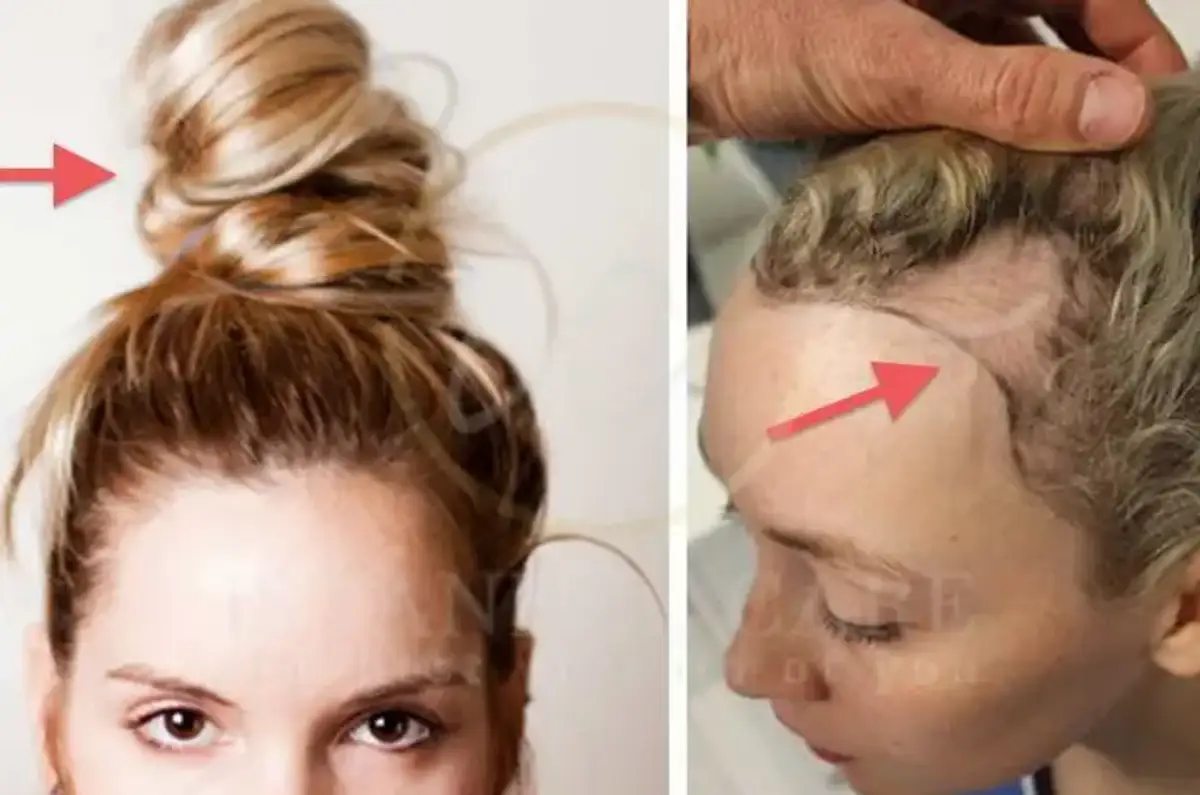 Frontal fibrosing alopecia signs risks and treatment