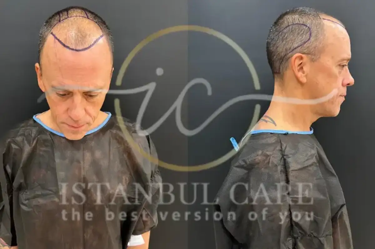 Hairline Transplant Procedure Benefits and Results
