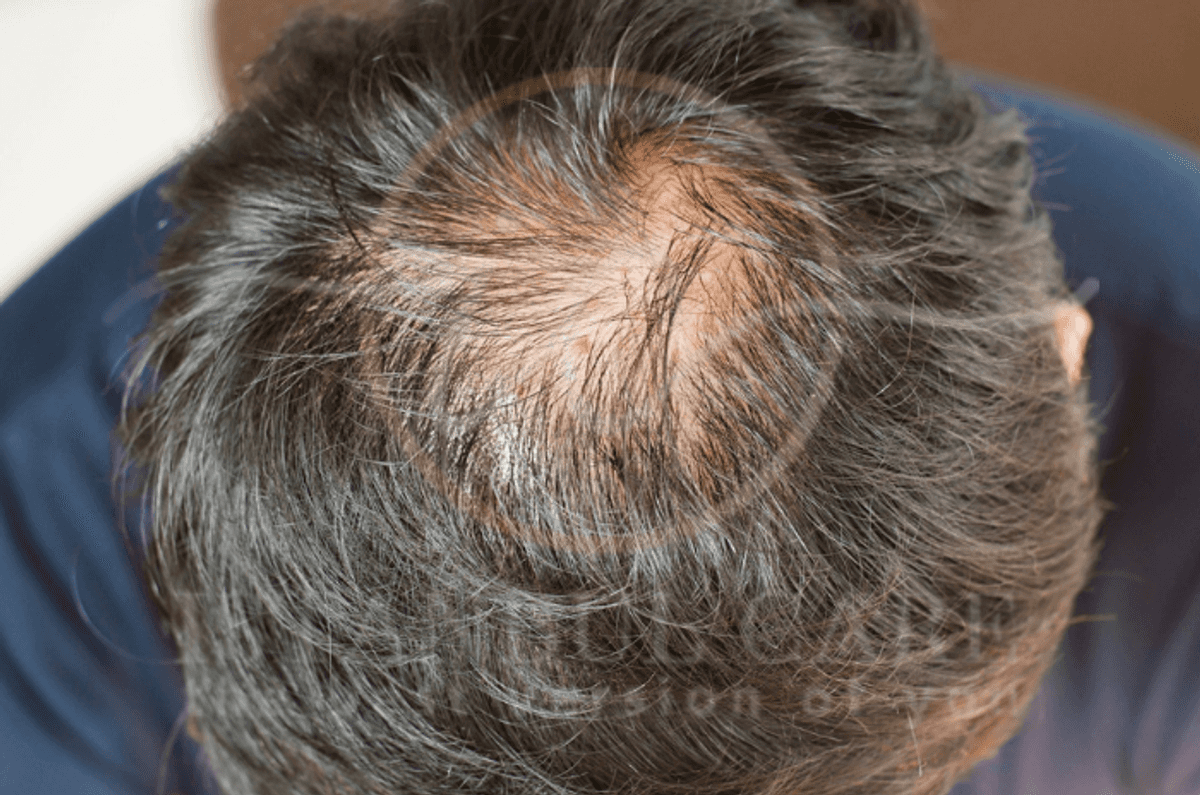 Explicación de la caída diaria del cabello normal