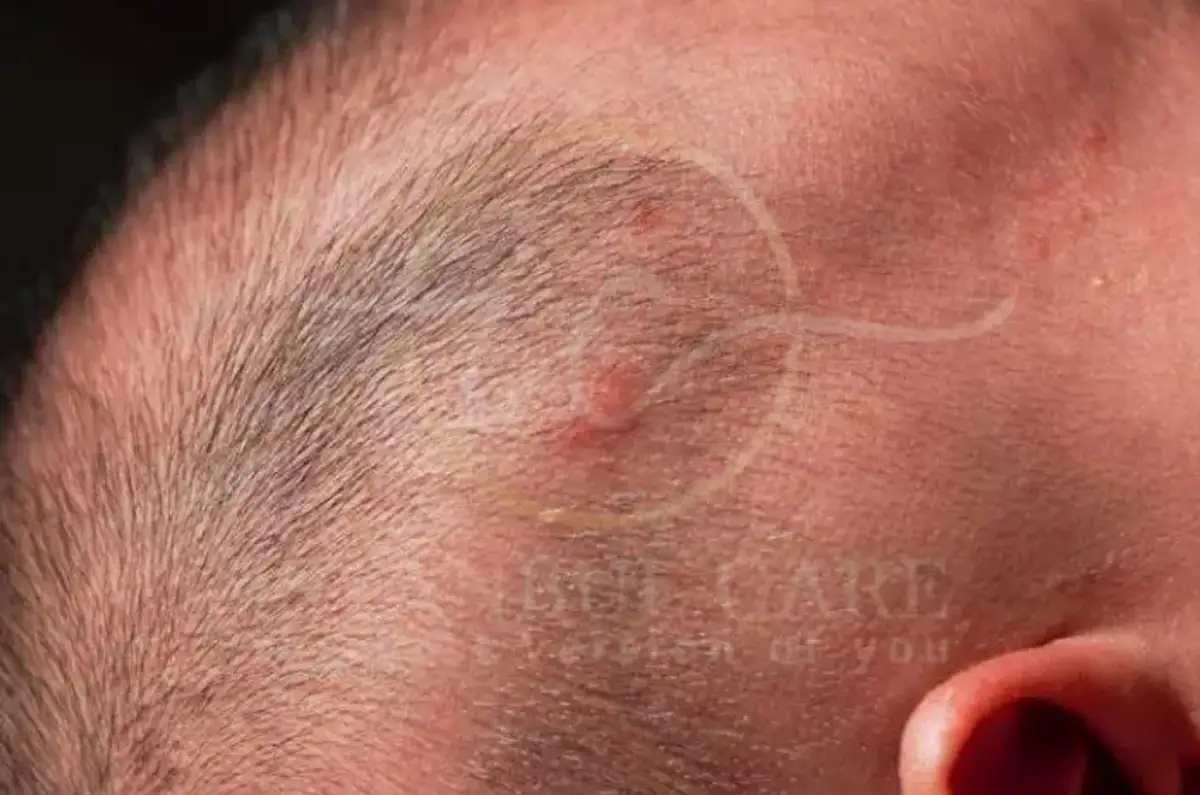 Pimples on Scalp Causes and Effective Treatments