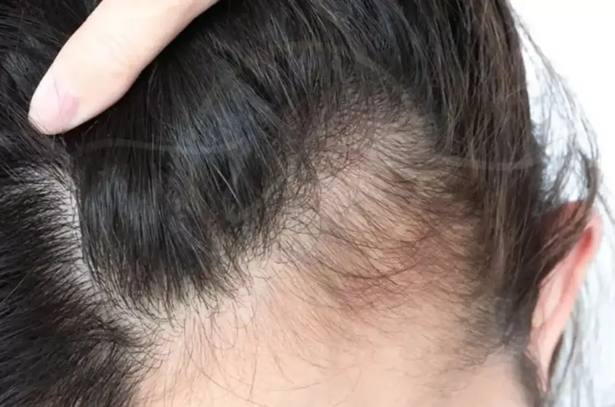 Traction Alopecia and Pattern Hair Loss
