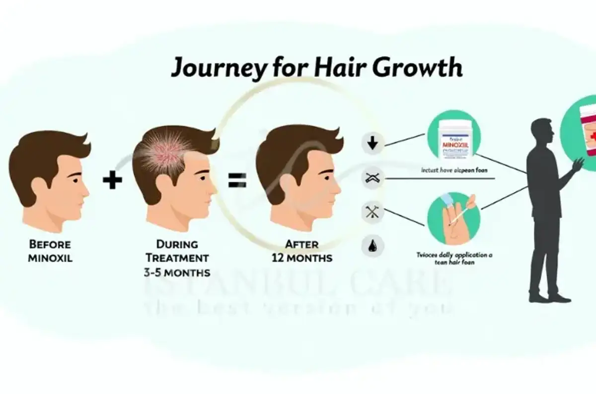 Attenzione a Questi Errori Comuni Quando si Applica il Minoxidil