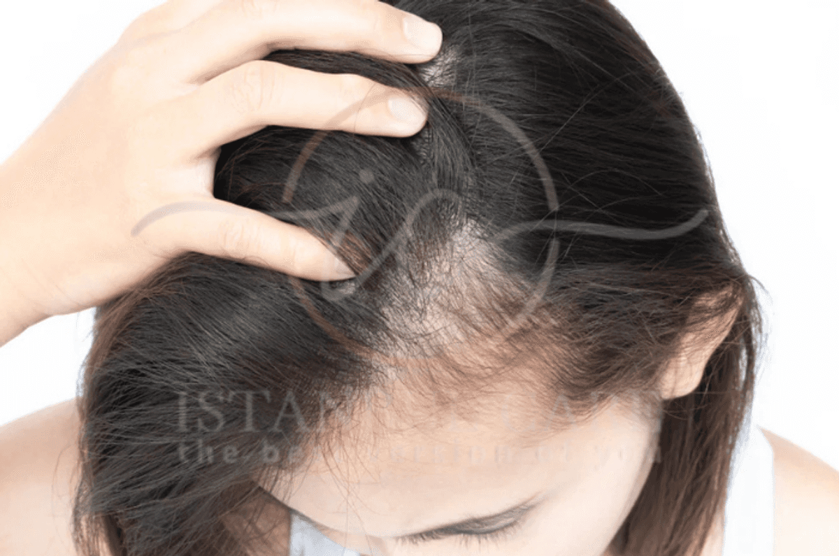 ¿Puede el estrés causar la caída del cabello? Tratamiento
