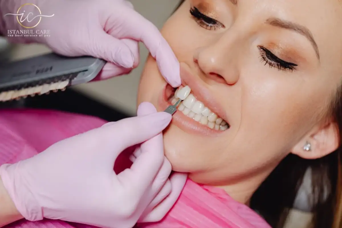 E-Max Veneers in Turkey Price