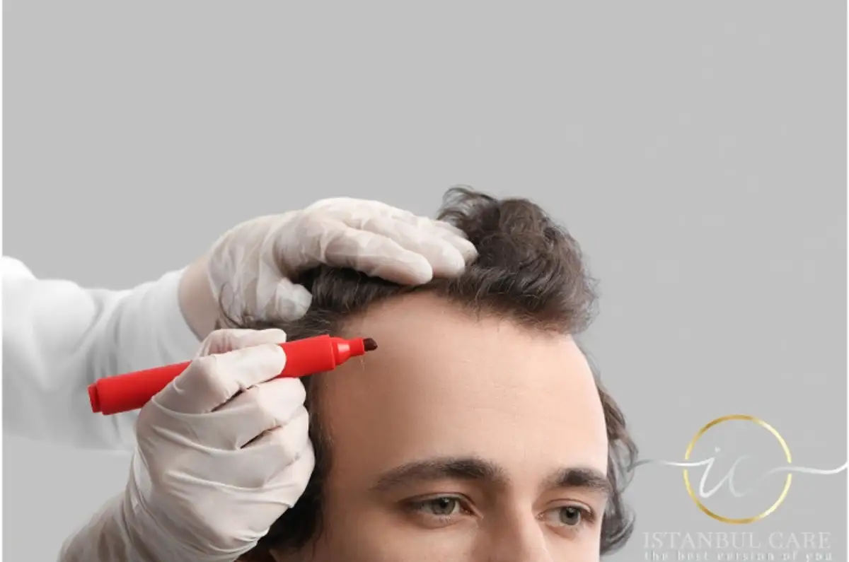 زراعة الشعر بتقنية FUE الياقوتية في ألبانيا