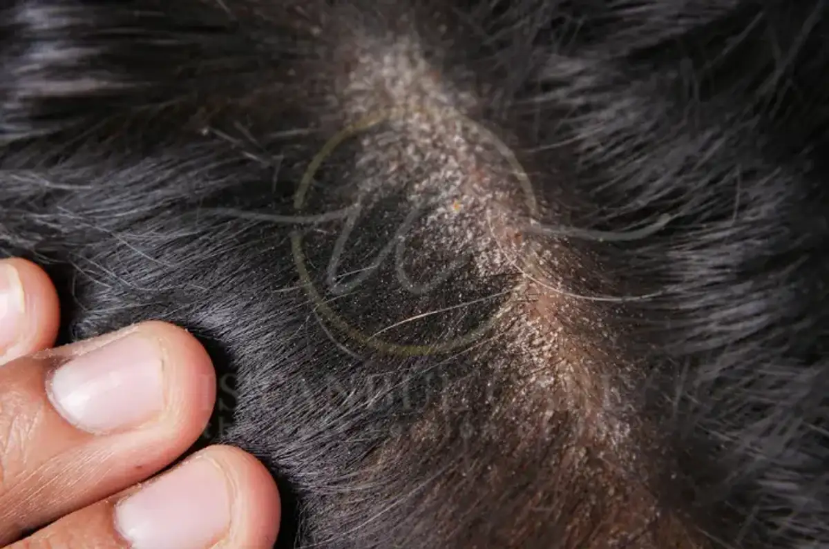How to Fix Dry Scalp Best Causes Symptoms (1)