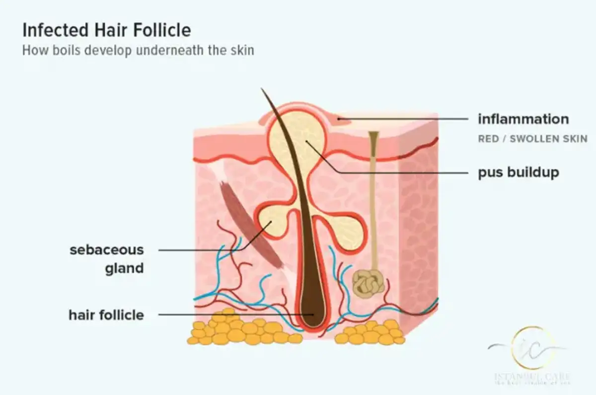 Primo piano di un pelo incarnito sulla pelle con arrossamento e infiammazione, che illustra cause e opzioni di trattamento.