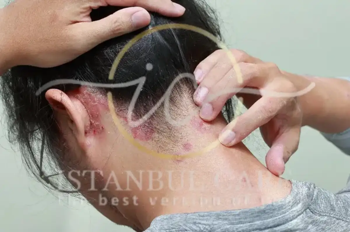 Scalp Psoriasis Treatment Options and Management