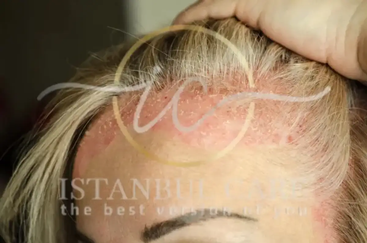 Scalp Psoriasis Treatment Options