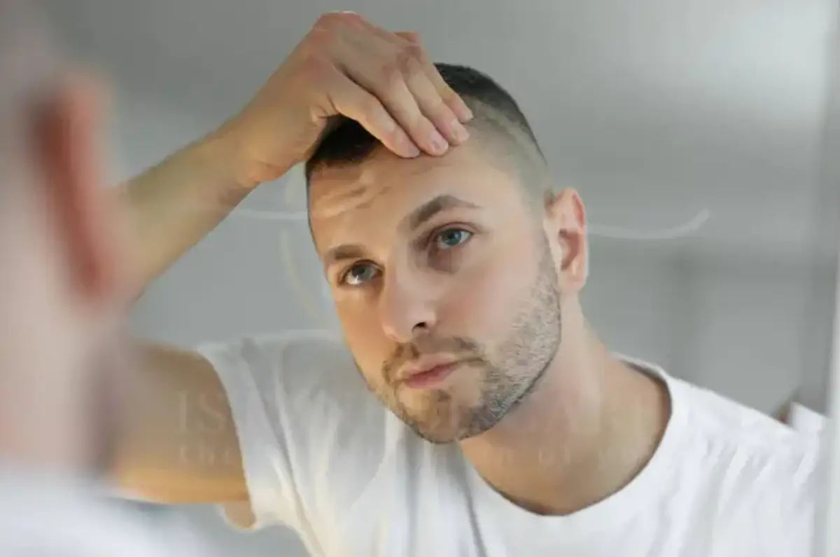 What is a Cowlick Hairline