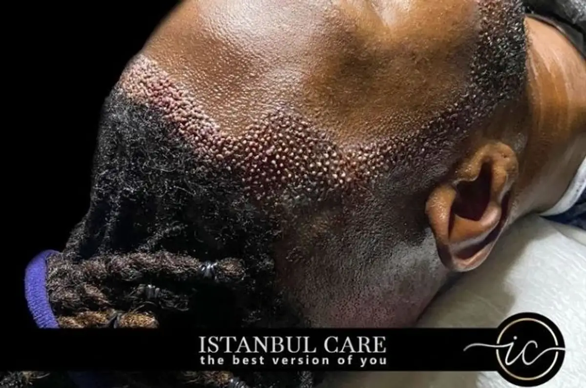 زراعة الشعر الأفريقي