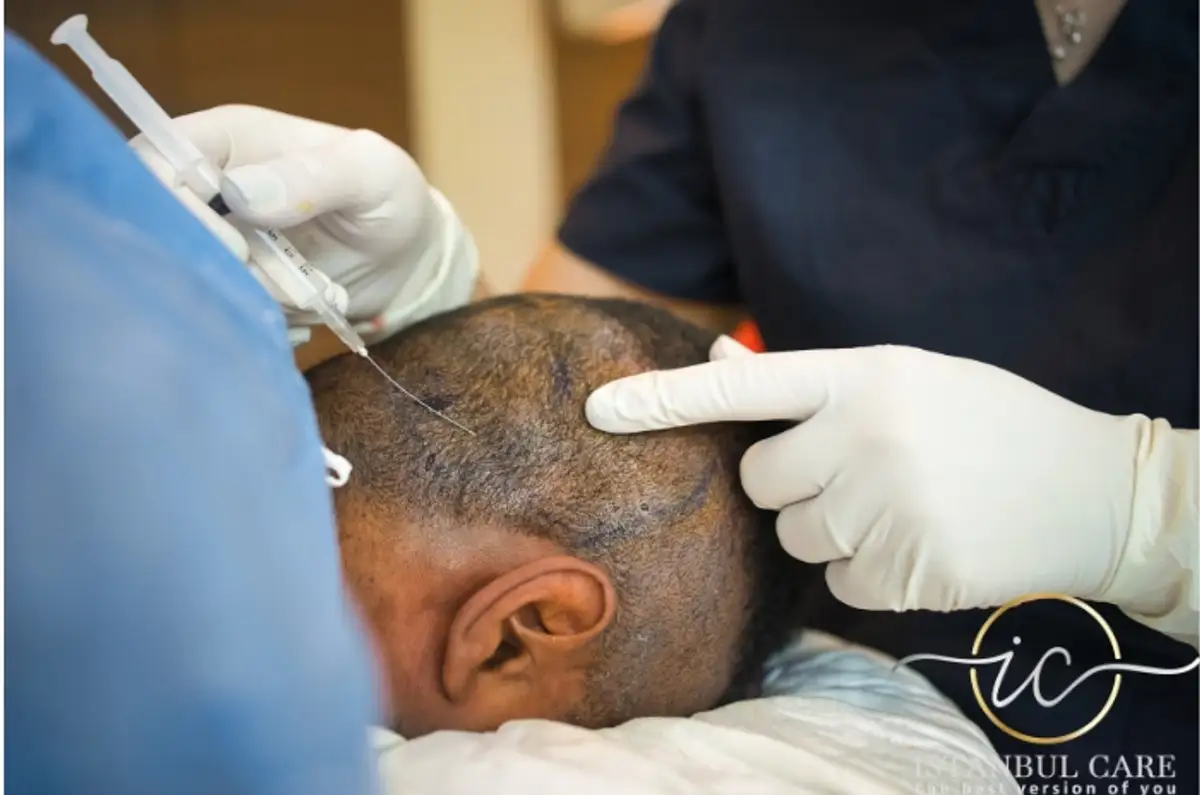 Saphir-Haartransplantation in der Türkei