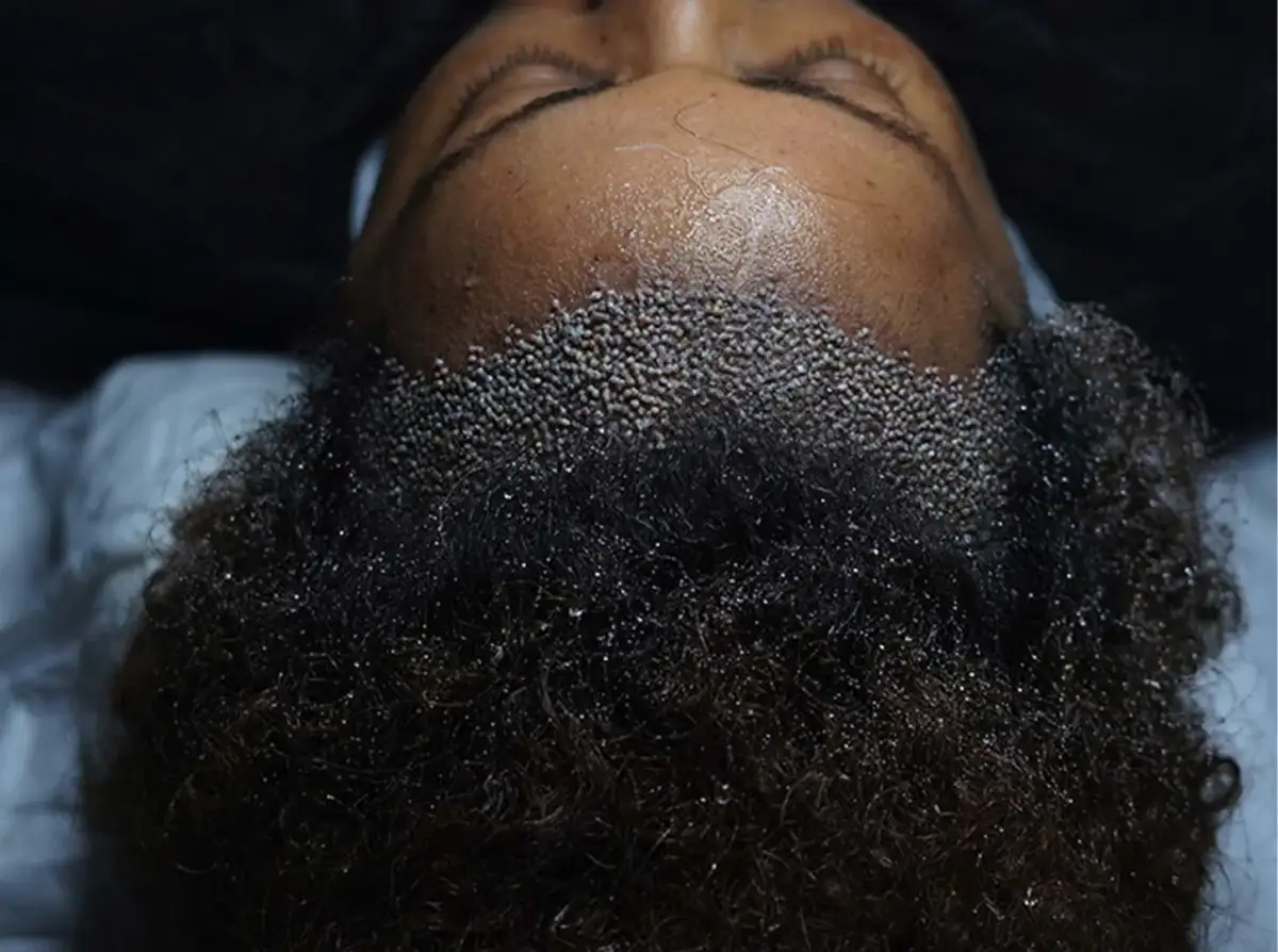 Afro Hair Transplant