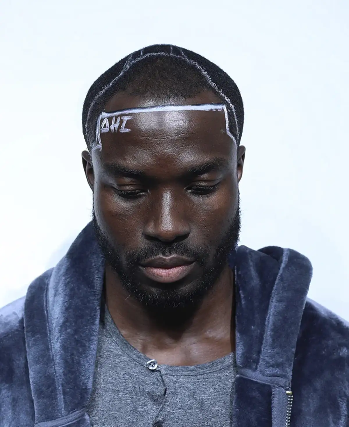 Un paciente no identificado fotografiado con la cabeza hacia abajo, con gorro quirúrgico y una nueva línea de cabello dibujada en la frente con marcador blanco.