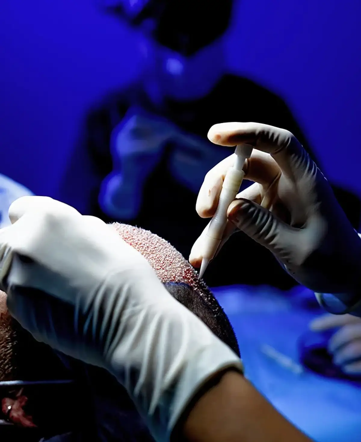 Gloved hands holding an implanter over the shaved scalp of an unidentified patient under blue theatre lighting, with grafts already placed across the front.