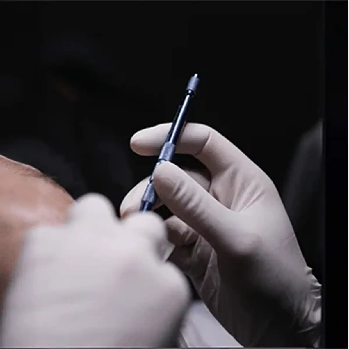 Close-up of a gloved hand holding a fine bladed instrument used to open recipient channels in the scalp.