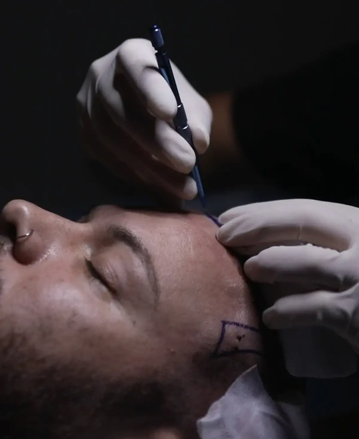 Gloved hands working over the forehead of an unidentified patient lying back, with a planned hairline drawn on the skin in marker.
