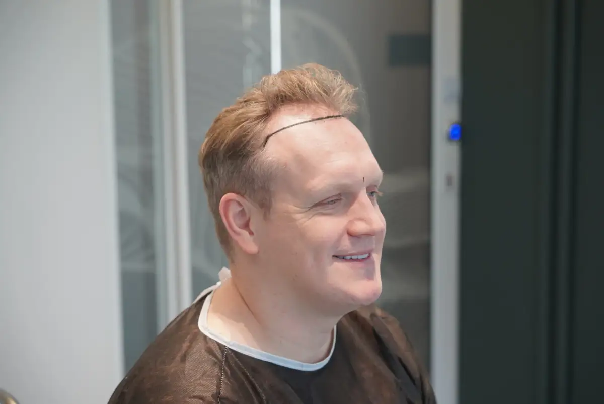 مريض زراعة شعر مصور من الجانب وهو يرتدي ثوب العيادة، مع رسم خط الشعر المخطط على جبهته بقلم جراحي.