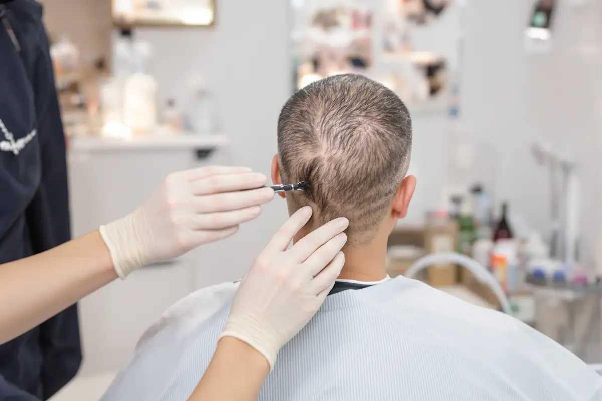 Top Hair Transplant Techniques in Istanbul Explained