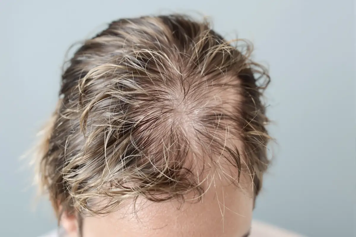 Can Dandruff Cause Hair Loss and How to Stop It