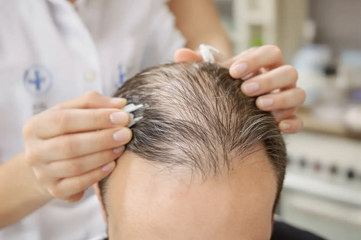 Chirurgia capelli: soluzioni moderne e sicure