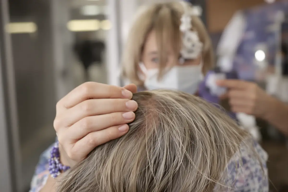 Comprendre les causes de la perte de cheveux due au COVID et la récupération