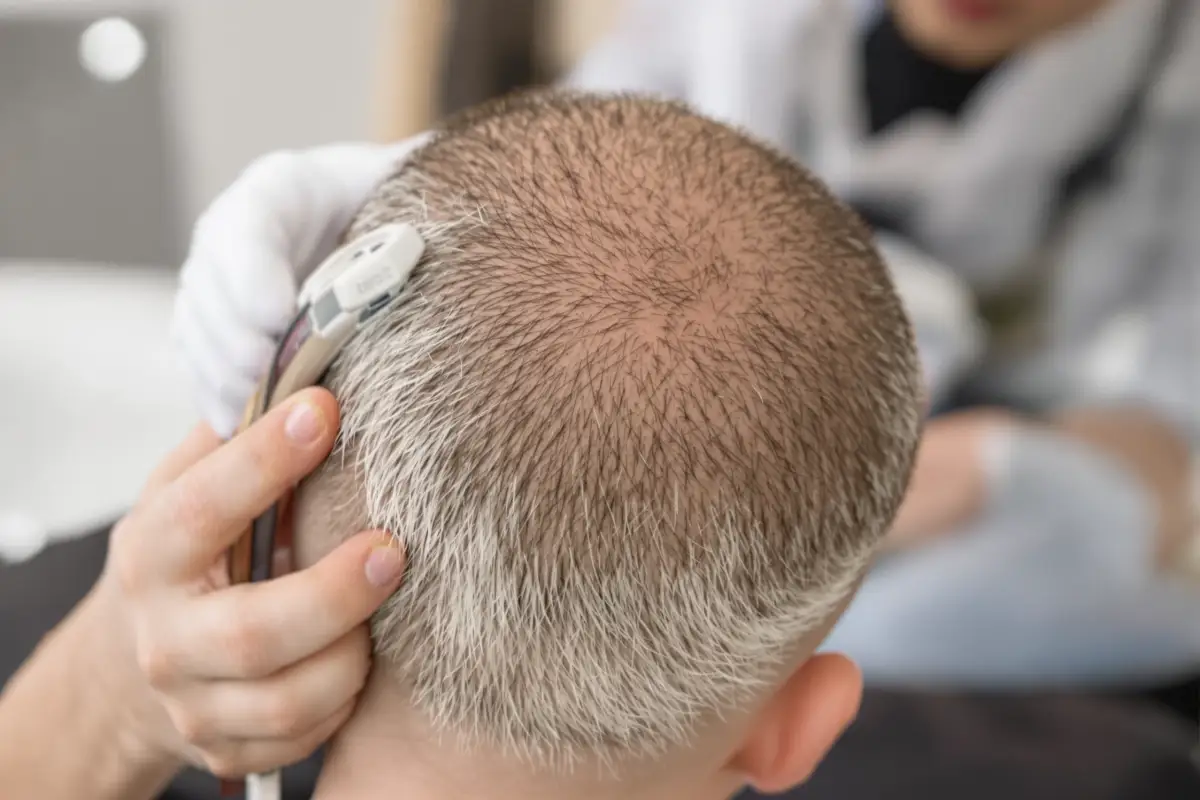 Caduta dei capelli da Alopecia Areata: Sintomi, Cause e Trattamento